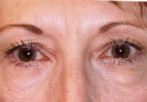 Eyelid Lifts for Milwaukee Patient Provides a Younger Looking Appearance